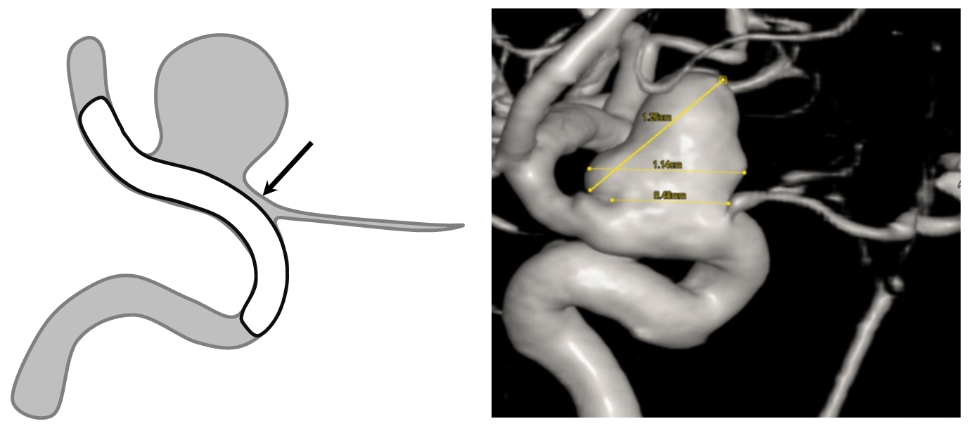 Pipeline Aneurysm Treatment