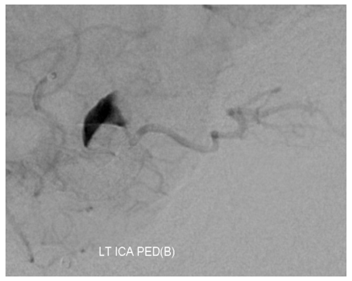 Pipeline Aneurysm Treatment