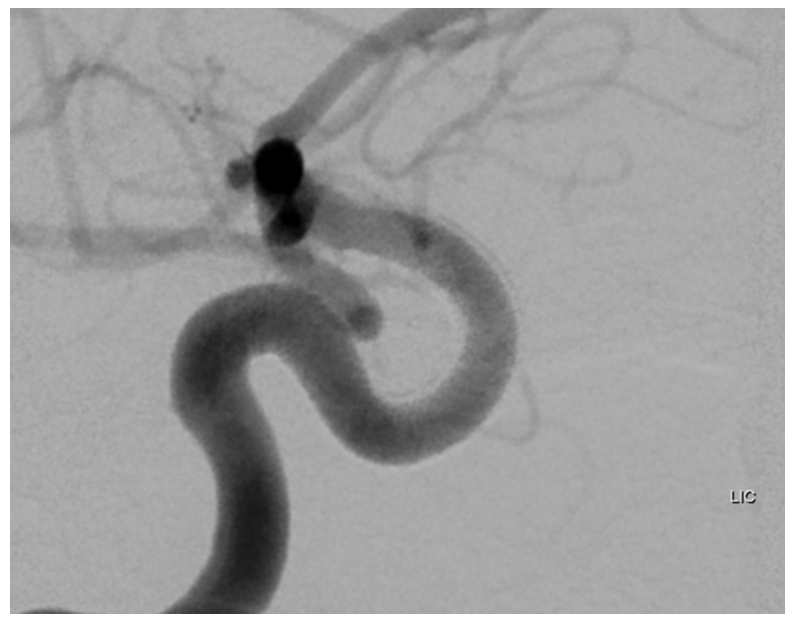 Pipeline Aneurysm Treatment