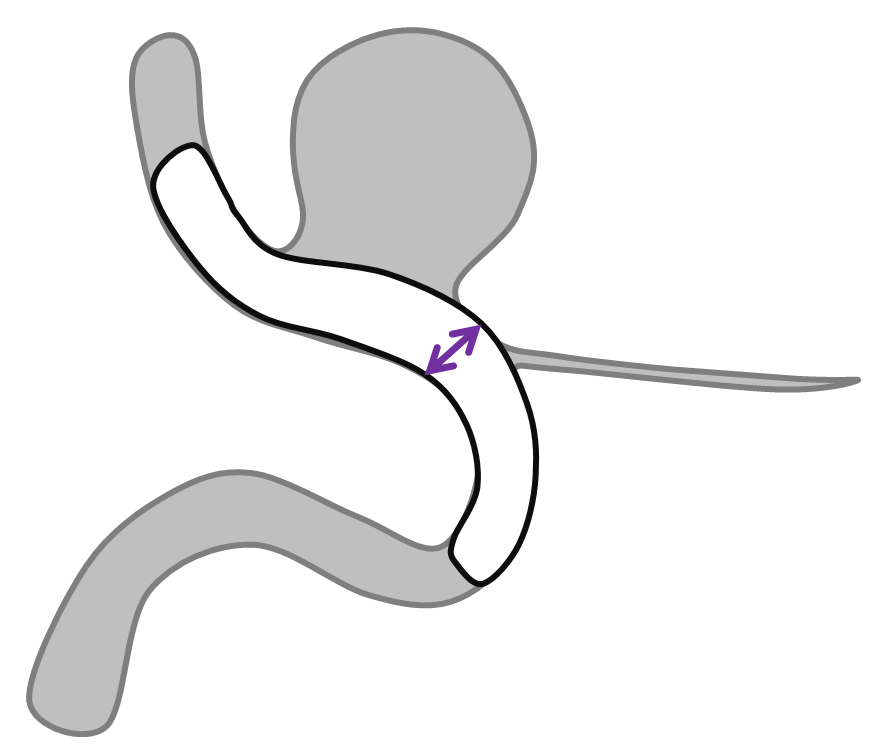 Pipeline Aneurysm Treatment