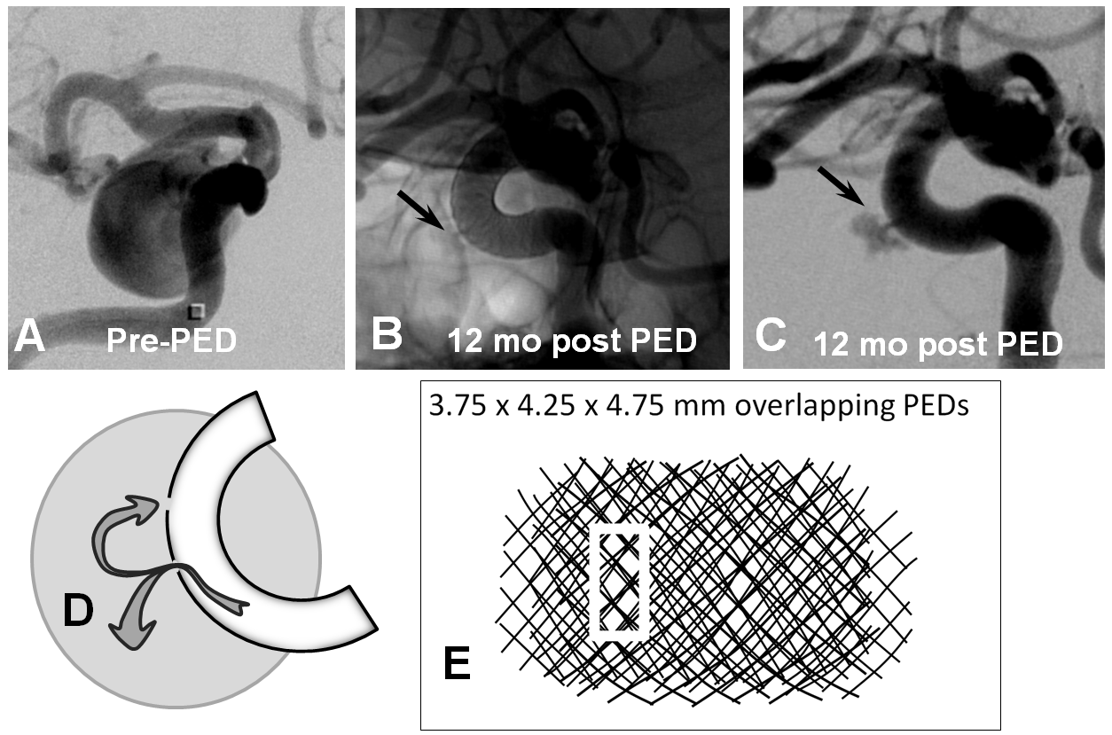 pipeline aneurysm treatment