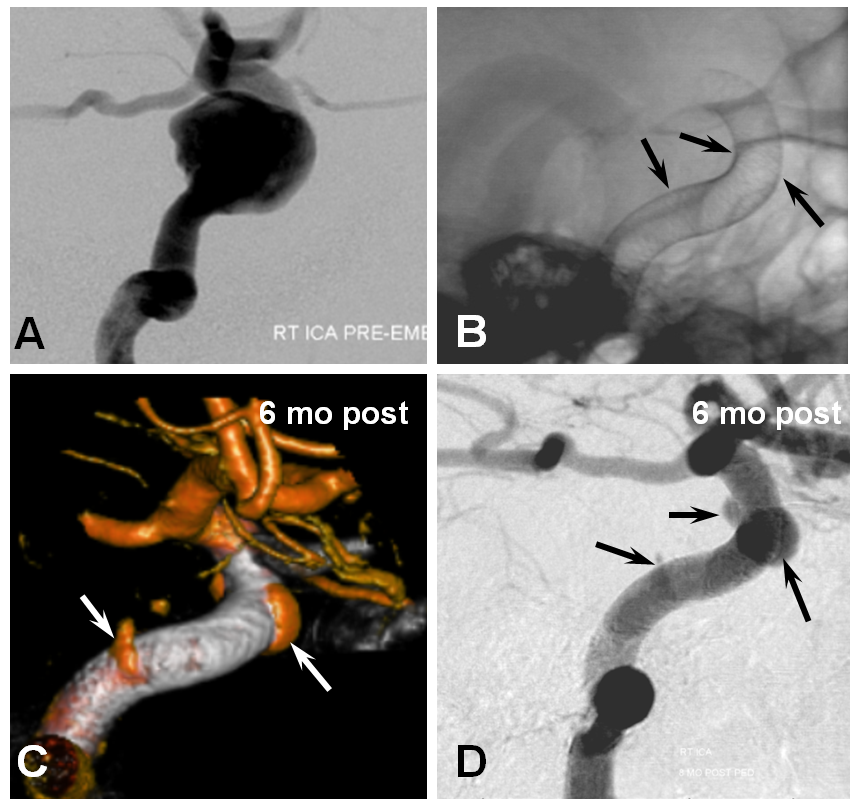 Pipeline Aneurysm Treatment