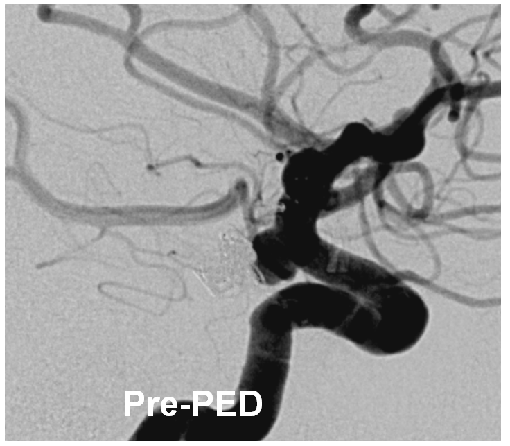 pipeline aneurysm treatment