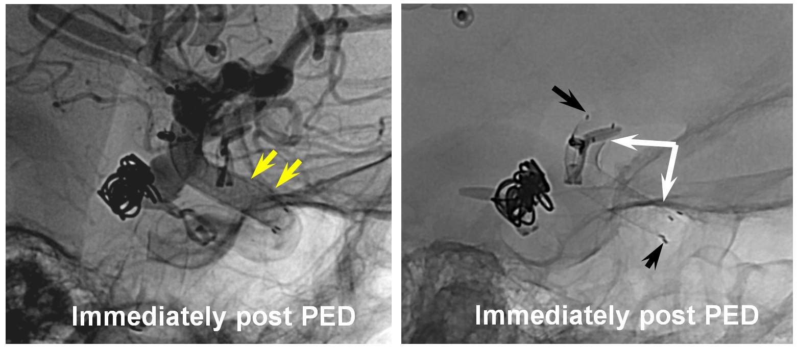 pipeline aneurysm treatment