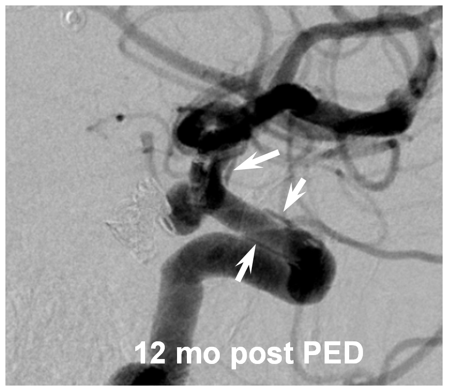 pipeline aneurysm treatment