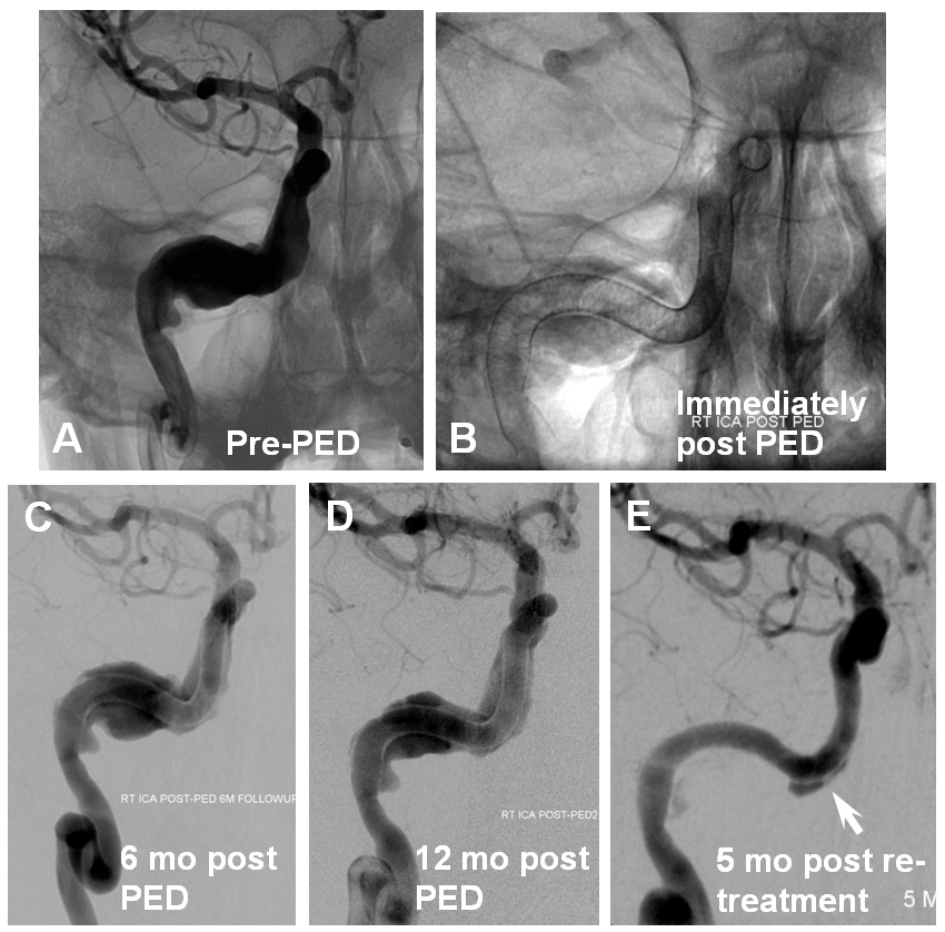 Pipeline Aneurysm Treatment