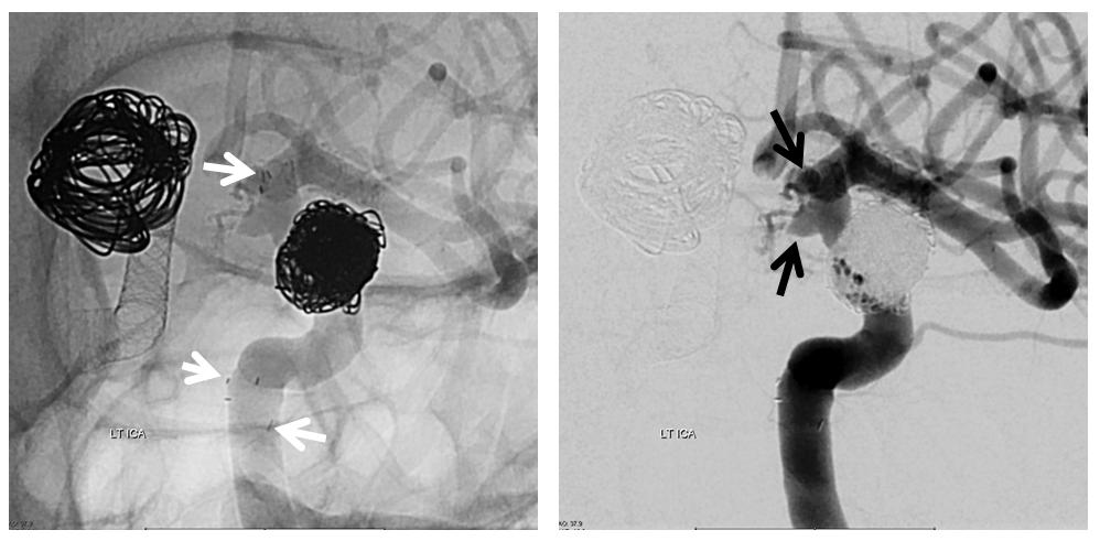 Pipeline Aneurysm Treatment