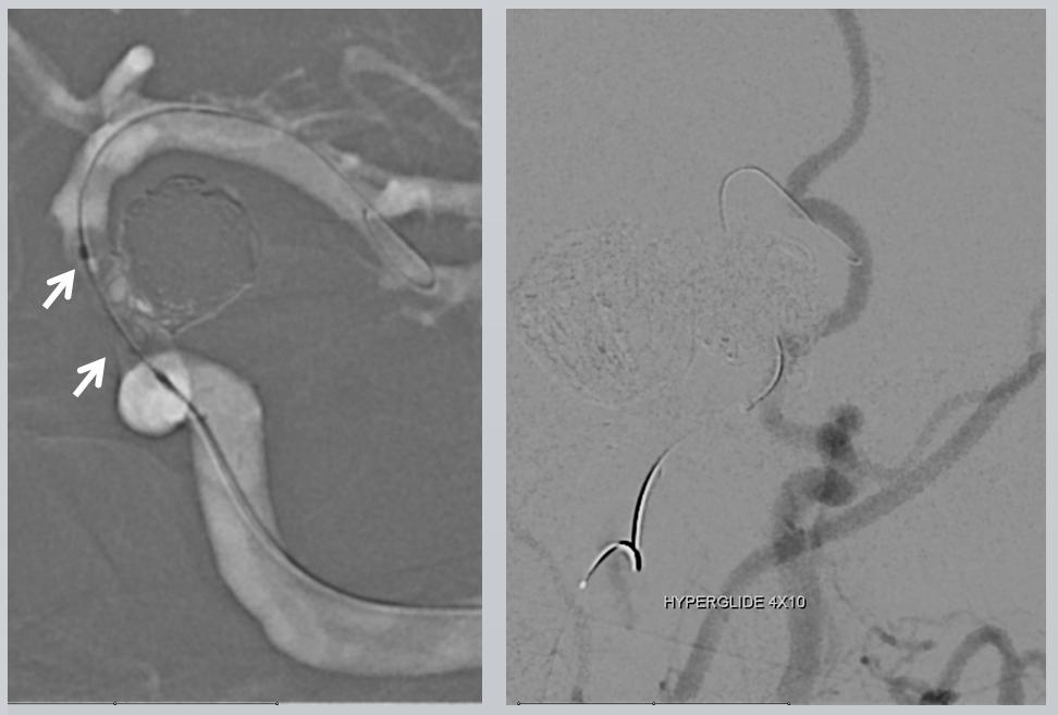 Pipeline Aneurysm Treatment