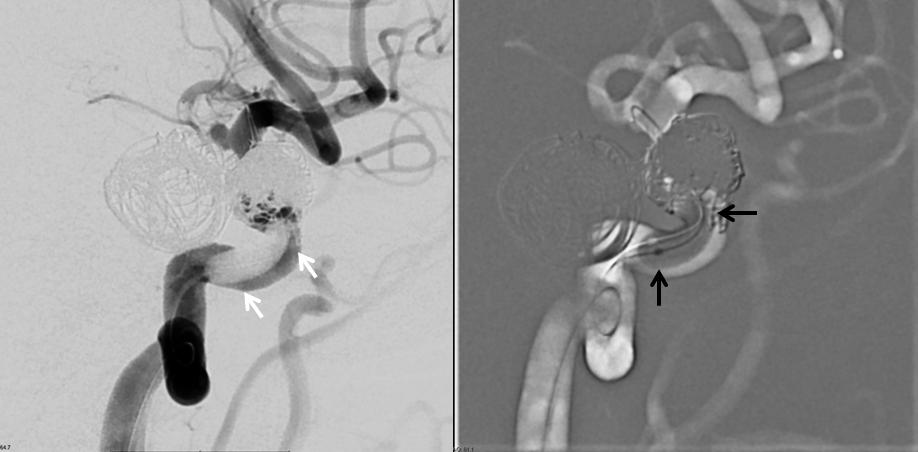 pipeline aneurysm tratement