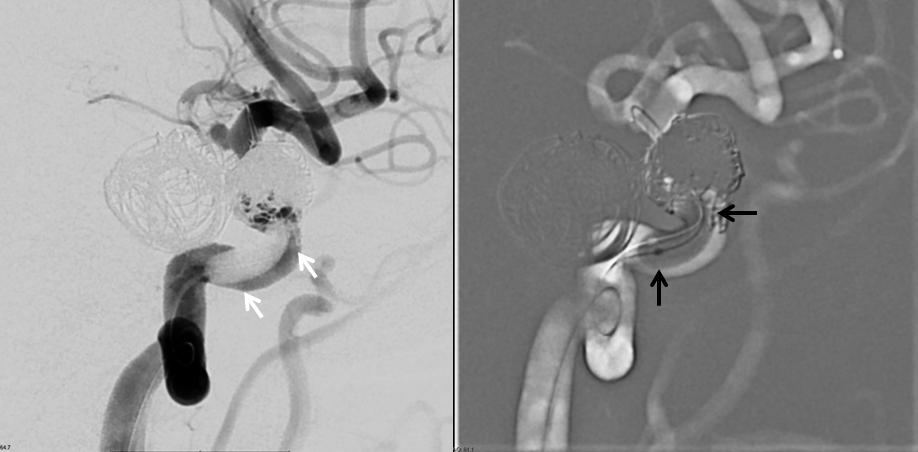 pipeline aneurysm tratement