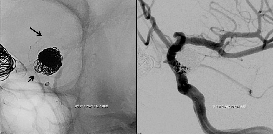 pipeline aneurysm treatment