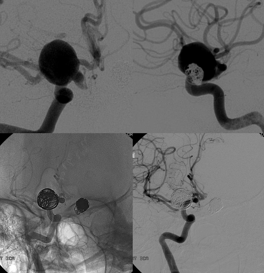 pipeline aneurysm treatment