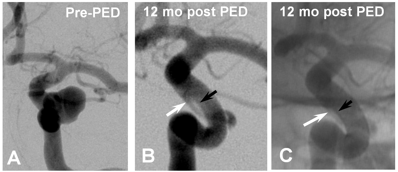 Pipeline Aneurysm Treatment