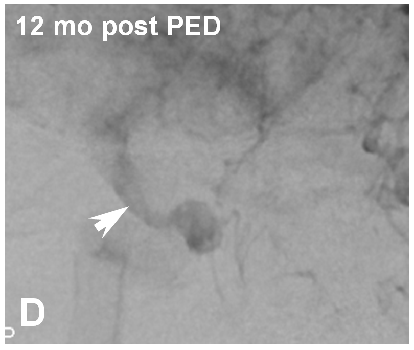 Pipeline Aneurysm Treatment