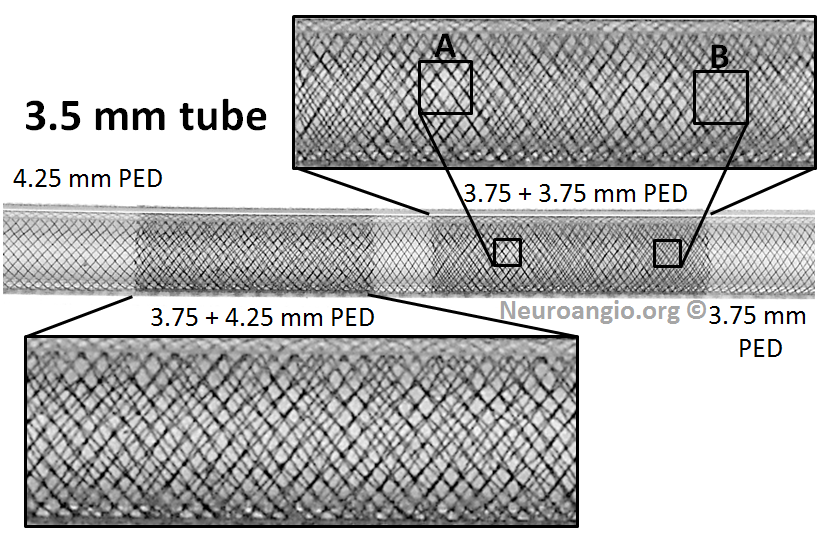 pipeline aneurysm treatment