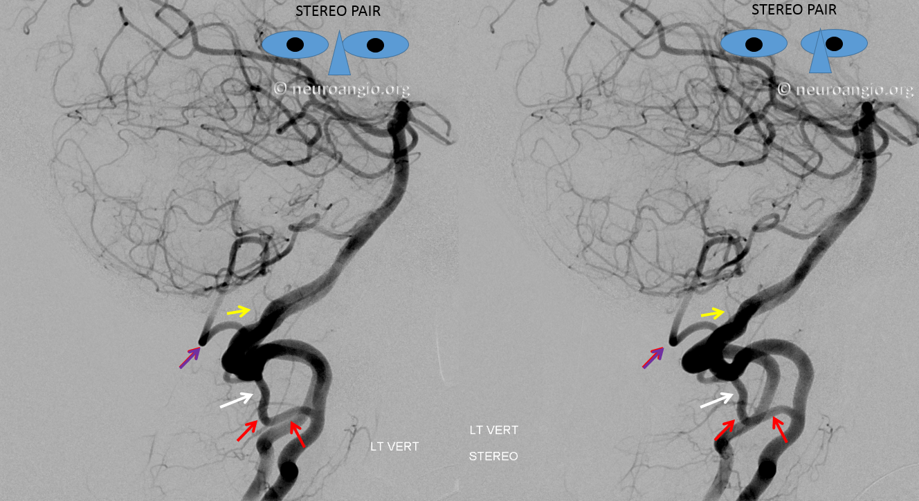 http://www.neuroangio.org/wp-content/uploads/PICA/PICA_C2_origin_Lateral.png