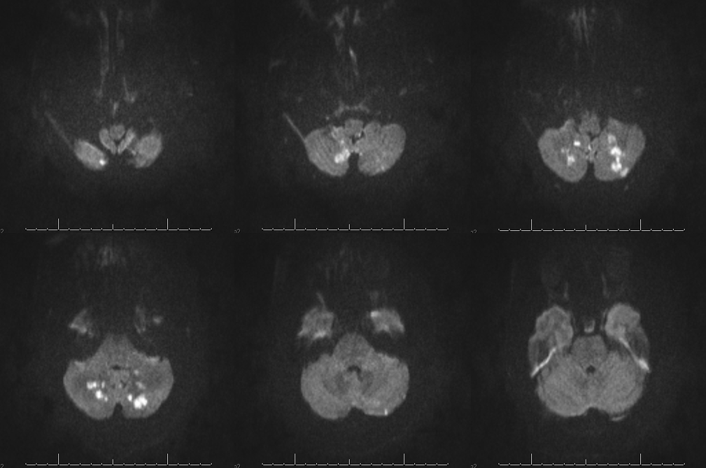 bihemispheric PICA stroke lateral spinal reconstitution