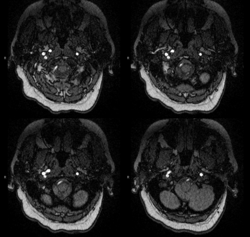 bihemispheric PICA stroke lateral spinal reconstitution