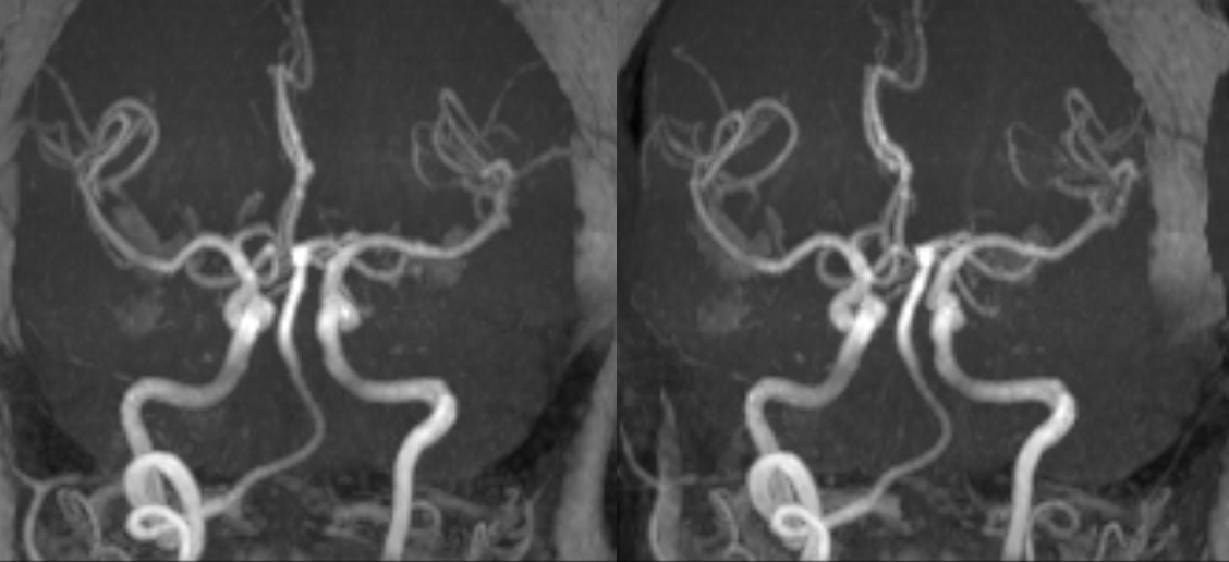 bihemispheric PICA stroke lateral spinal reconstitution