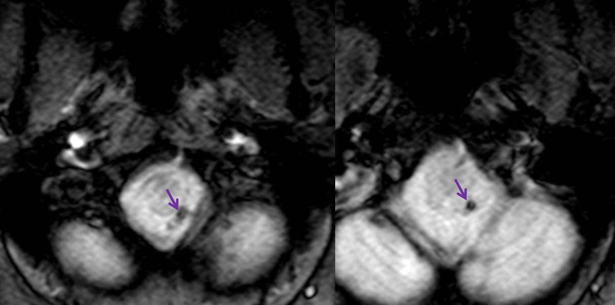 bihemispheric PICA stroke lateral spinal reconstitution