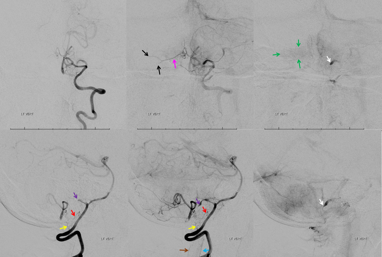 bihemispheric stroke lateral spinal reconstitution of PICA