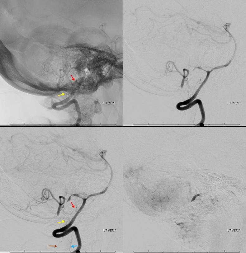 bihemispheric PICA stroke lateral spinal reconstitution