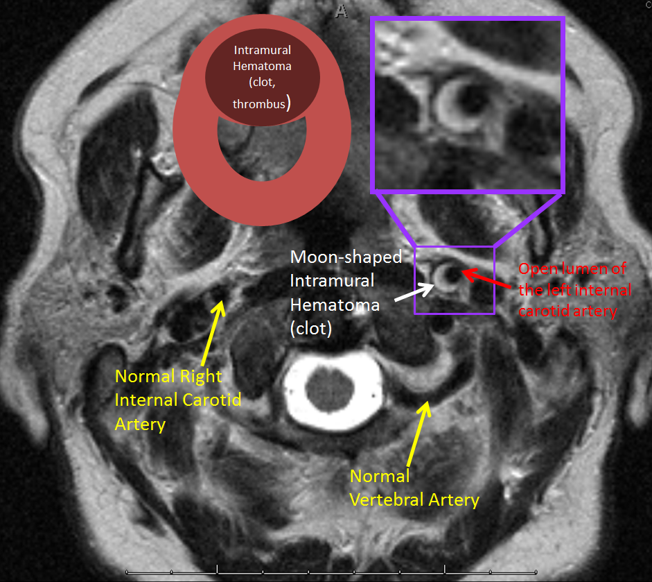 http://www.neuroangio.org/wp-content/uploads/Patient_Information/Dissection/Dissection_13.png