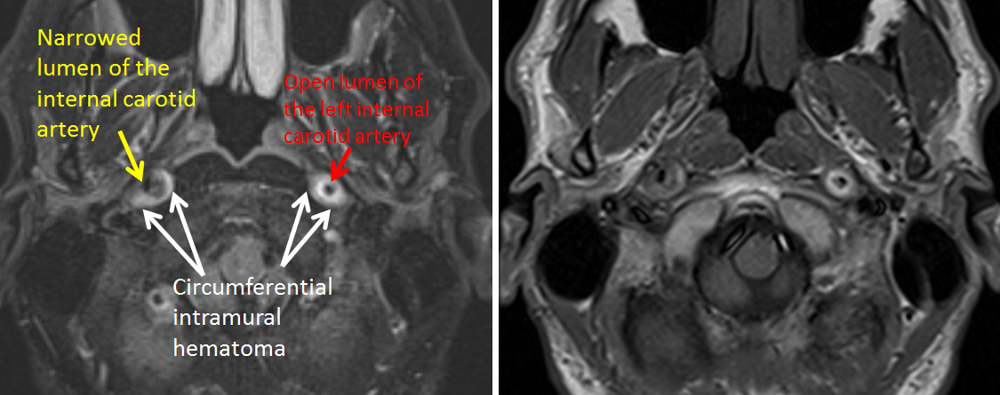 http://www.neuroangio.org/wp-content/uploads/Patient_Information/Dissection/Dissection_15.png