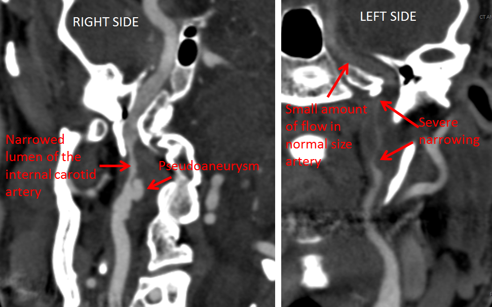 http://www.neuroangio.org/wp-content/uploads/Patient_Information/Dissection/Dissection_16.png