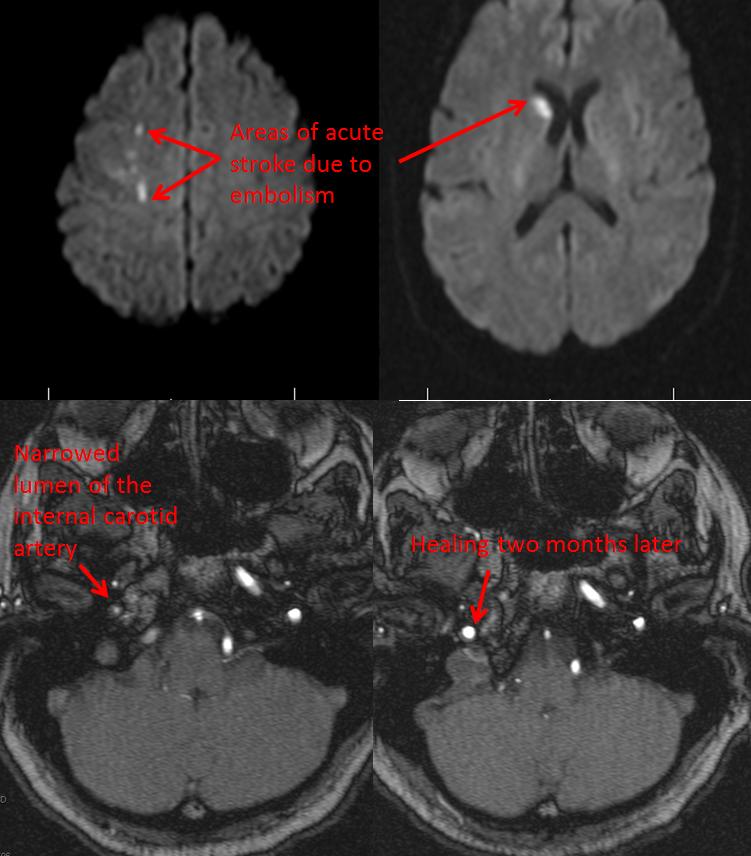 http://www.neuroangio.org/wp-content/uploads/Patient_Information/Dissection/Dissection_19.png