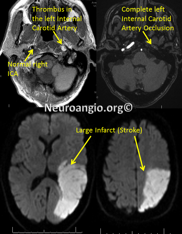 http://www.neuroangio.org/wp-content/uploads/Patient_Information/Dissection/Dissection_20.png