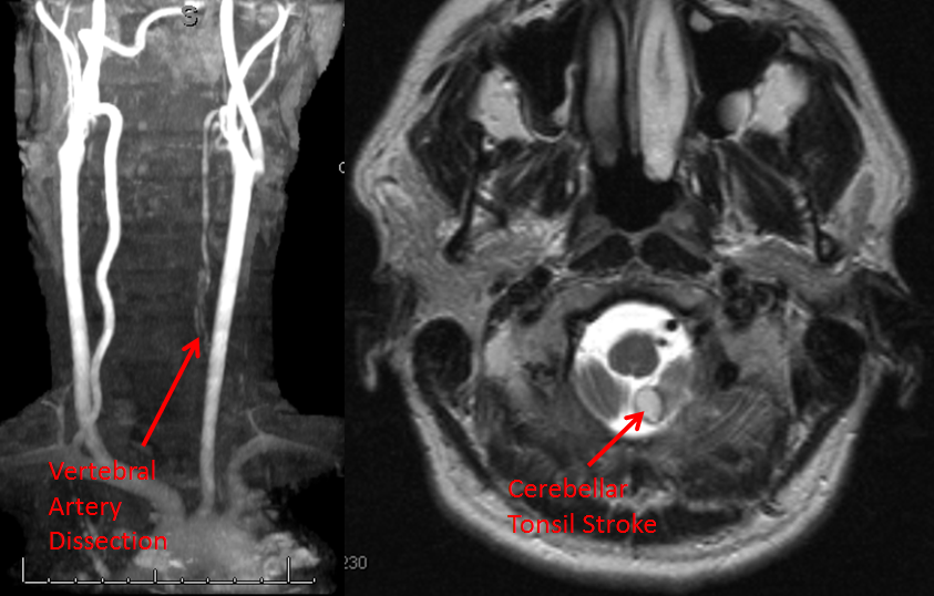 http://www.neuroangio.org/wp-content/uploads/Patient_Information/Dissection/Dissection_21.png