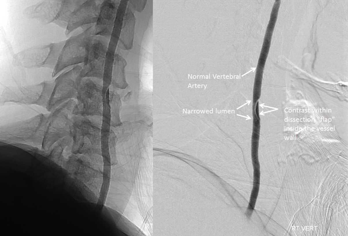 http://www.neuroangio.org/wp-content/uploads/Patient_Information/Dissection/Dissection_22.png