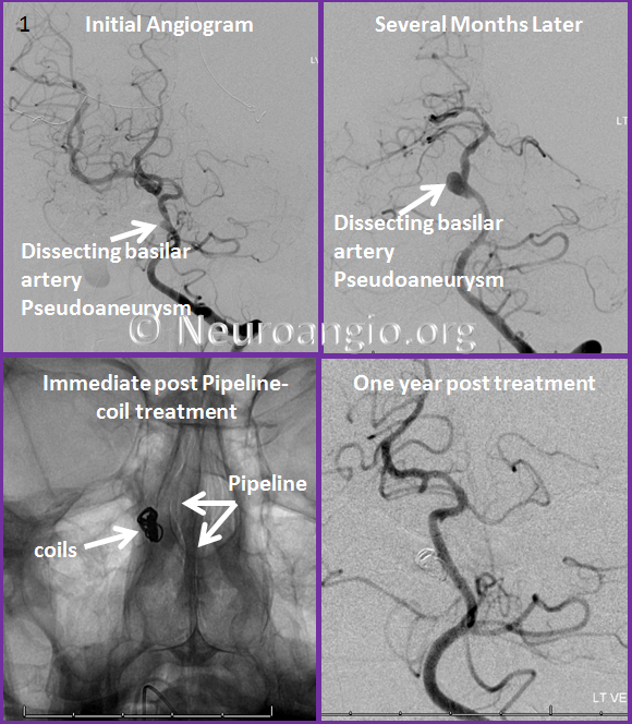 http://www.neuroangio.org/wp-content/uploads/Patient_Information/Dissection/Dissection_23.png