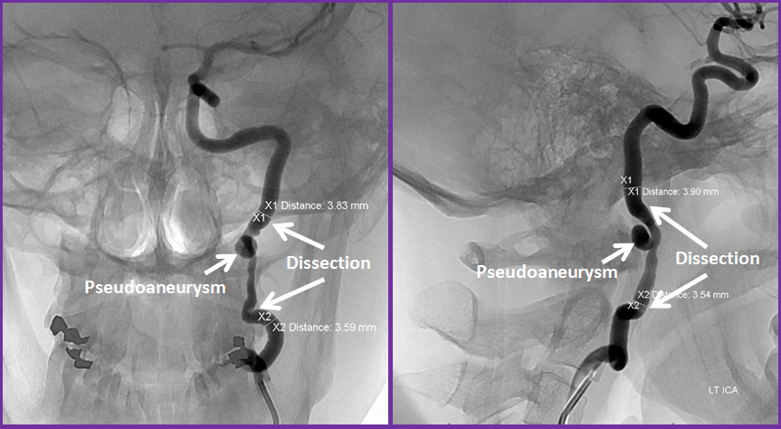 http://www.neuroangio.org/wp-content/uploads/Patient_Information/Dissection/Dissection_24.png