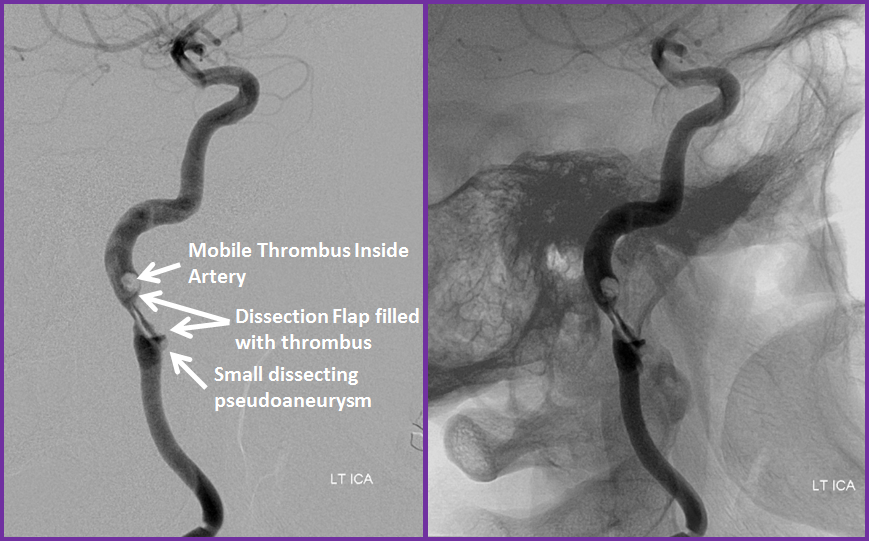 http://www.neuroangio.org/wp-content/uploads/Patient_Information/Dissection/Dissection_25.png