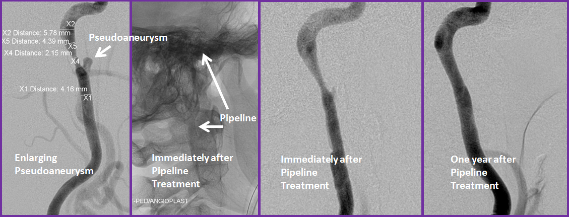 http://www.neuroangio.org/wp-content/uploads/Patient_Information/Dissection/Dissection_26.png