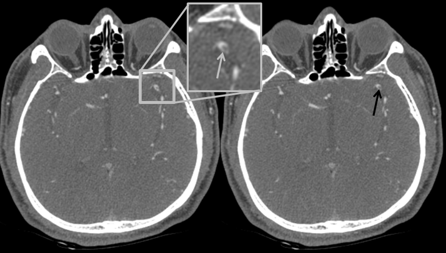 MCA dissection CTA