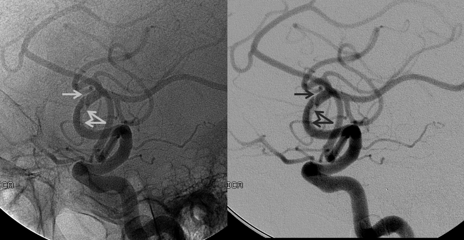 MCA dissection angio