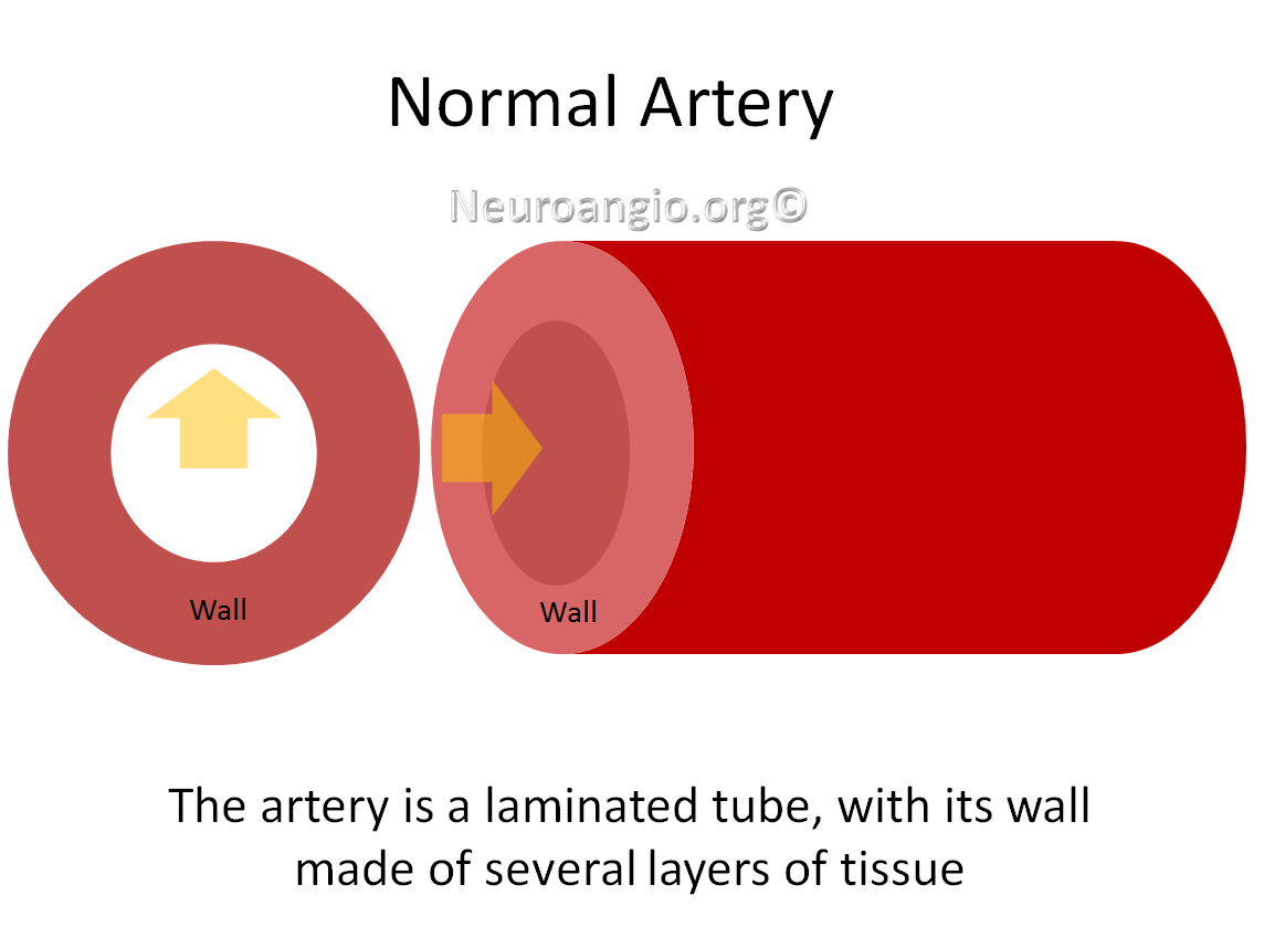 http://www.neuroangio.org/wp-content/uploads/Patient_Information/Dissection/Dissection_labels_01.png