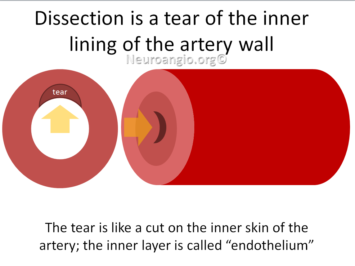 http://www.neuroangio.org/wp-content/uploads/Patient_Information/Dissection/Dissection_labels_02.png