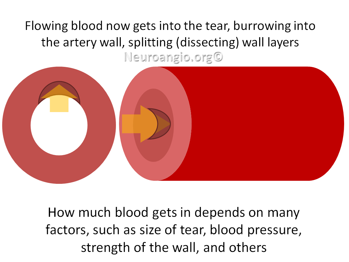 http://www.neuroangio.org/wp-content/uploads/Patient_Information/Dissection/Dissection_labels_03.png