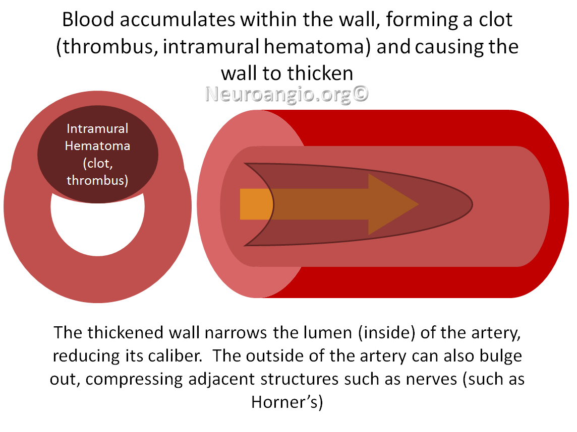 http://www.neuroangio.org/wp-content/uploads/Patient_Information/Dissection/Dissection_labels_04.png