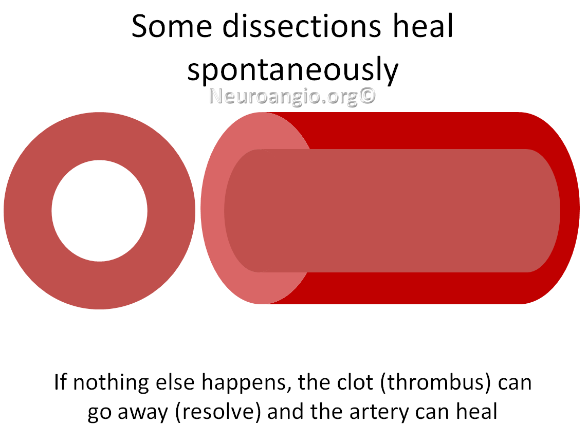 http://www.neuroangio.org/wp-content/uploads/Patient_Information/Dissection/Dissection_labels_05.png