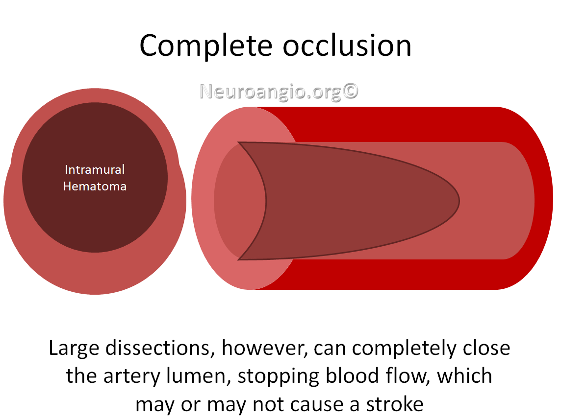 http://www.neuroangio.org/wp-content/uploads/Patient_Information/Dissection/Dissection_labels_06.png