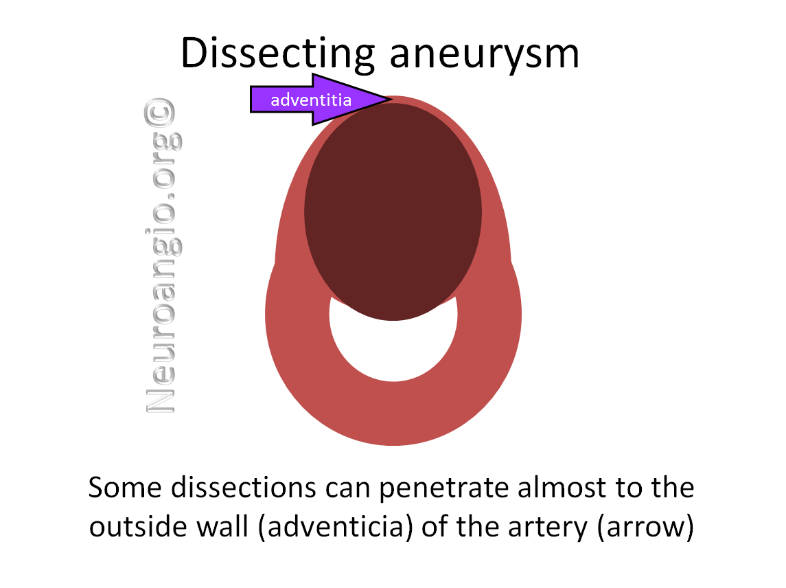 http://www.neuroangio.org/wp-content/uploads/Patient_Information/Dissection/Dissection_labels_07.png