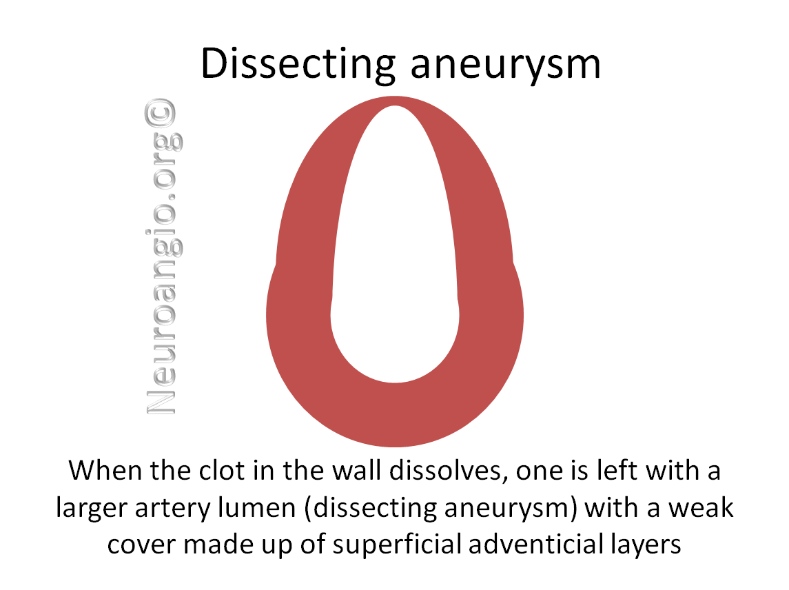 http://www.neuroangio.org/wp-content/uploads/Patient_Information/Dissection/Dissection_labels_08.png