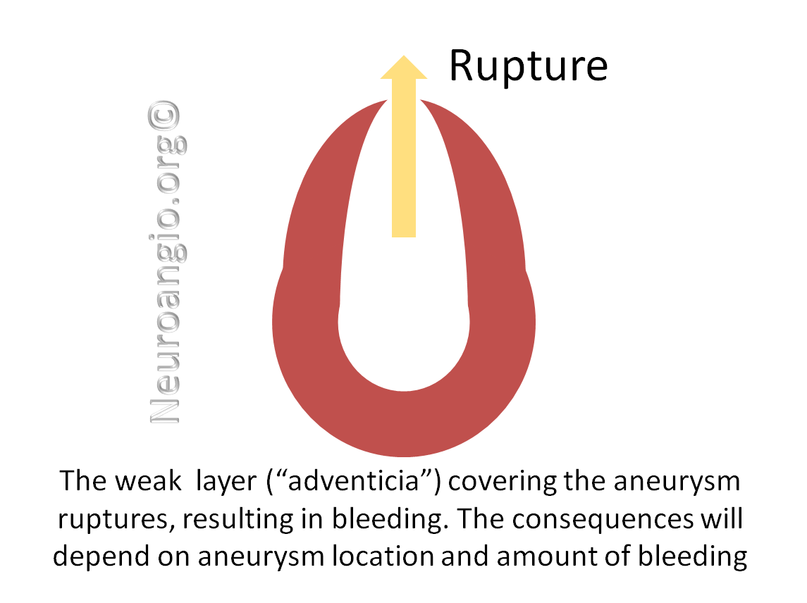 http://www.neuroangio.org/wp-content/uploads/Patient_Information/Dissection/Dissection_labels_09.png