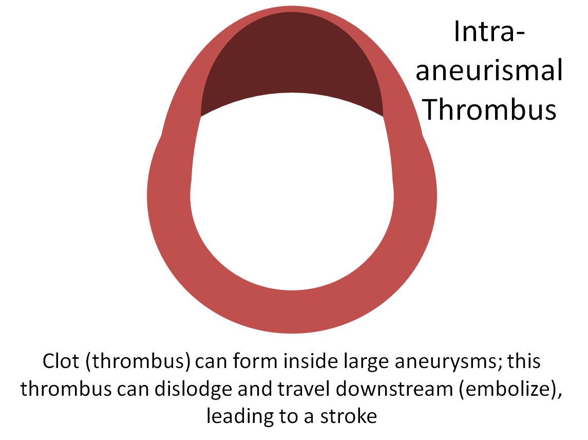 http://www.neuroangio.org/wp-content/uploads/Patient_Information/Dissection/Dissection_labels_11.png