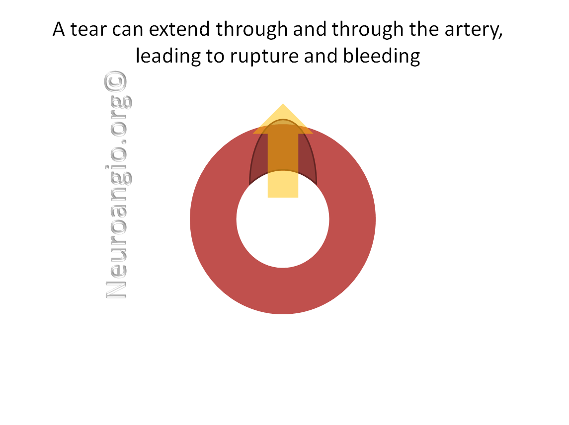 http://www.neuroangio.org/wp-content/uploads/Patient_Information/Dissection/Dissection_labels_12.png